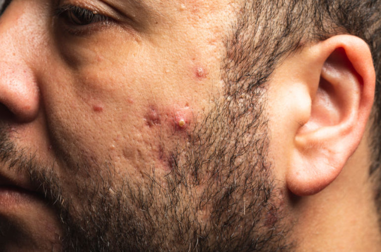 Como reduzir a acne esteróide
